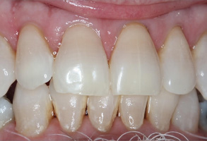Perfect Smile Dental Studio | Fluoride Treatment, Invisalign reg and Veneers