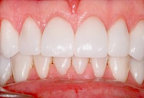 Perfect Smile Dental Studio | Dental Cleanings, Invisalign reg and Full Mouth Reconstruction