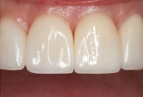 Perfect Smile Dental Studio | Crowns, Cosmetic Dentistry and Fluoride Treatment